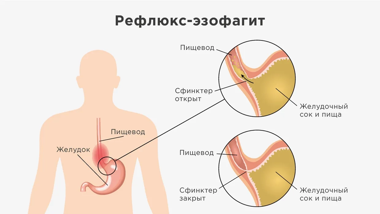 Язва желудка: симптомы, причины, диагностика и лечение | Блог ЛДЦ Здоровье